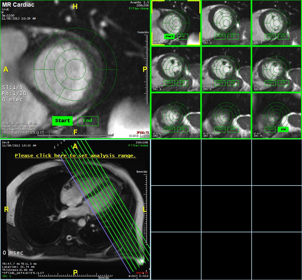 Manual EF Ejection fraction on the left ventricle is calculated automatically by default. The measurements are verified to be accurate with artificial digital phantom data.