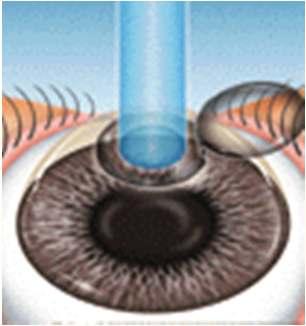 Laser Eye Surgery LAser in SItu Keratomileusis (Lasik) 2.