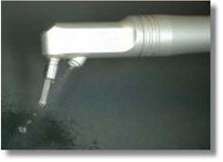 Laser Dentistry Laser Water jet Major advantage is no drilling