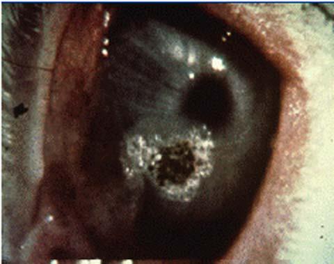 04 μm NIR Detected by dilating eyes and inspecting back of eye Corena