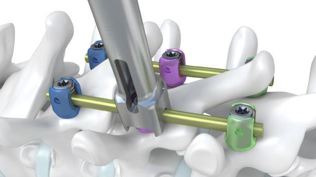 ANAX TM OCT Spinal System 9-1. Persuader (Optional) OS0200 PERSUADER Use the PERSUADER to introduce the titanium rod into the polyaxial screw housing U shape channel.
