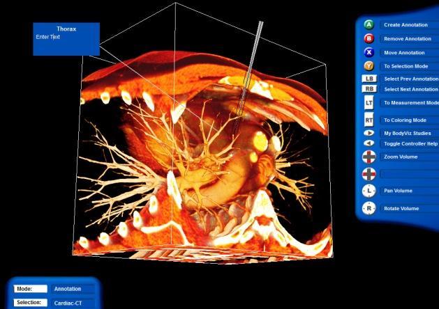 In the screen shot at the left, the user has windowed down to view the muscular structures as well as bone and artery/vein structures.
