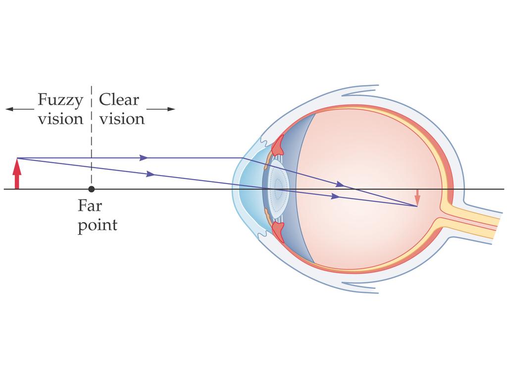 Lenses in Combination and Corrective Optics A nearsighted person has a far point that is a finite distance away; objects