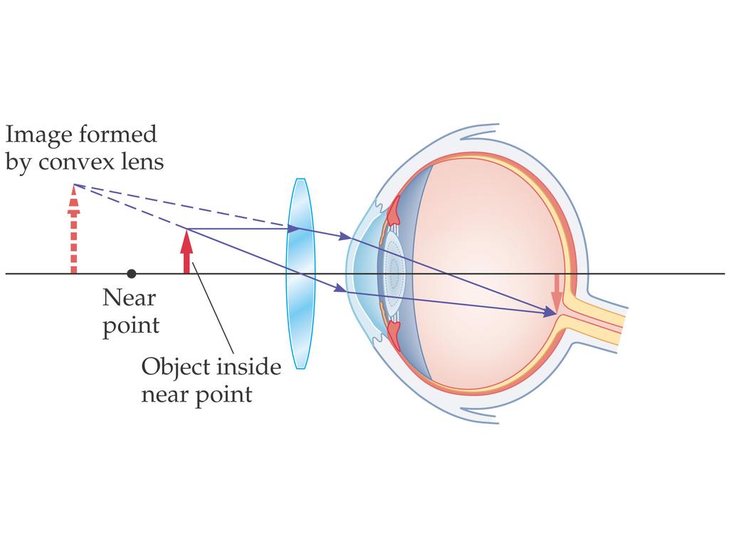Lenses in Combination and Corrective Optics To correct farsightedness, a converging lens