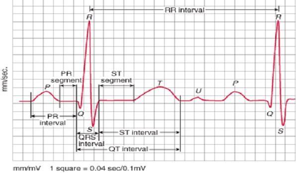 ECG Critical Point Detection and Feature Extraction The critical points P,Q,R,S,T were identified using MATLAB A time window of 25s used for processing ECG samples and extracting the ECG features