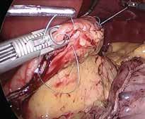 Clinical advantages of the The suture is not dragged through the hole alongside the needle,