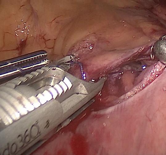 I can suture along the abdominal wall, gaining full thickness bites, tie intracorporeally, easily do a running stitch thru mesh, even trocar port closure efficiently.