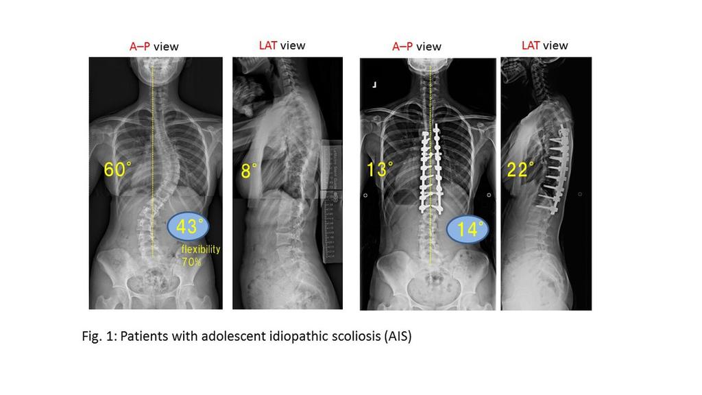 Fig. 1: Patients with adolescent idiopathic scoliosis (AIS) Surgery is usually indicated for 50 or 40 curves in skeletally