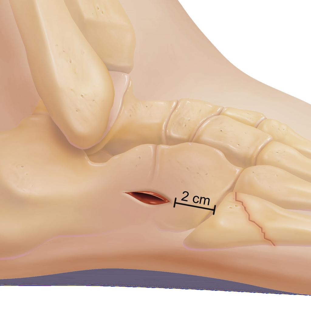 Place a K-wire on the lateral aspect of the foot and use fluoroscopy to position the pin overlapping and parallel to metatarsal