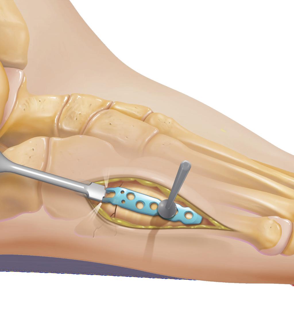 5th Metatarsal Fracture System Hook Plate 1 Expose the tuberosity of the fifth metatarsal.