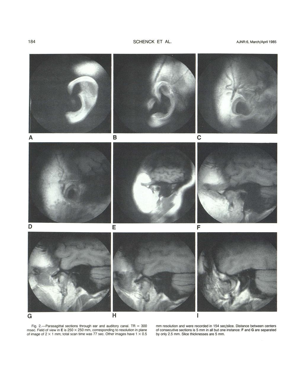 184 SCHENCK ET AL. AJNR:6, March/April 1985 A B c G H Fig. 2.-Parasagittal sections through ear and auditory canal. TR = 300 msec.