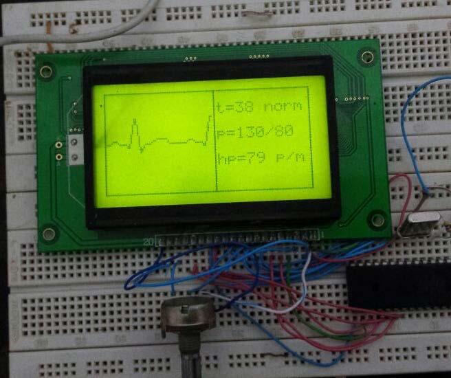 Fig. 15. GLCD interfaces with AVR MCU 4. Results In this paper, a MCU_Based multi parameter patient monitor has been designed and implemented.