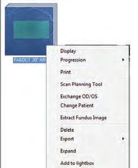 Print Multiple Images on a Page How to Print Multiple Images on a Single Page (OCT) Figure 70: Expand OCT 1. Click and drag the desired OCT scan(s) to the Lightbox. a. If printing single images from a volume scan, right-click on the volume scan and select Expand to choose the desired images (Figure 70).