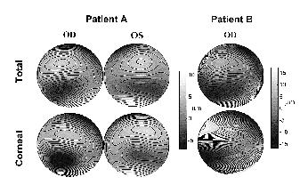 Figure 4. Wave aberration patterns (without tilts and defocus) in the three measured eyes, for total aberrations (upper row) and corneal aberration (lower row). Contour lines are plotted every 1 µm.