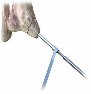 5. Tap the screw head (Optional) Note: In areas of increased bone density, it may be beneficial to tap prior to screw insertion. Using the 4.