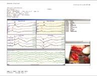 hardcopy/screen copy Print event list, trendgraphs, EEG, EMG or waterfall