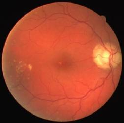 Many research efforts in the last several years have been devoted to developing automatic tools to help in the detection and evaluation of diabetic retinopathy lesions.