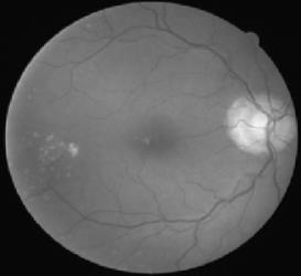 This proposed preprocessing technique enhances the quality of retinal image and removes noise, which could be easy to segment the retinal features to identify the diabetic retinopathy.