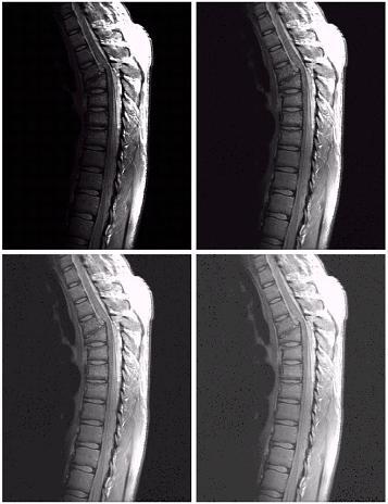Another example : MRI a c b d (a) a magnetic resonance image of an upper thoracic human spine with a fracture dislocation and spinal cord impingement The picture is predominately dark An expansion