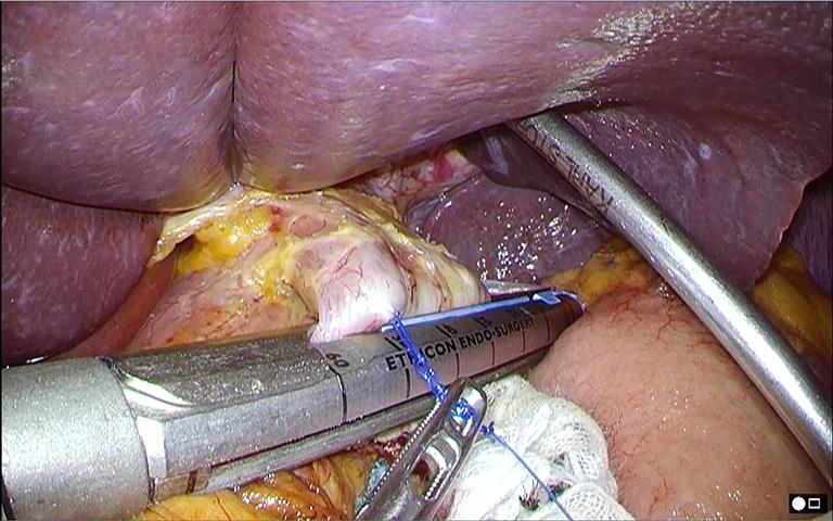 the first assistant; () the esophagus was clamped using a linear stapling device just distal to the site penetrated by the thread; () the