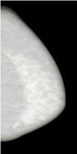 Figure 2: Simulated mammogram using the phantom shown in figure 1 for a Monte-Carlo code using noise-free primary radiation with a Source focus detector distance (SDD) of 650 mm.