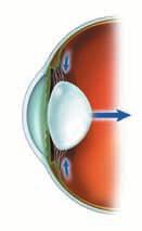 Most of the focussing of light in your eye is done by the cornea.