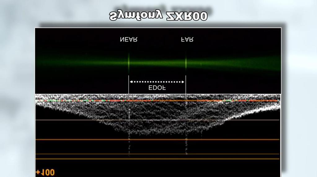 Visualising Optical Pathway of EDOF IOLs* Miniwell Ready Symfony ZXR00 Lentis 313 MF15 AT Lara 829 MP *Data on file and