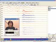 Accurate Digital video software: Video-link QP-110AK Synchronized digital video for EEG systems Patient images synchronized with the EEG waveforms can be