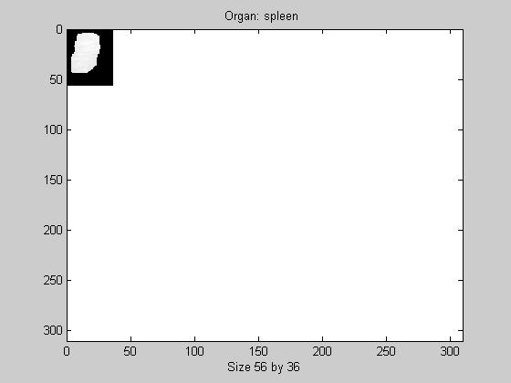 Figure 4: Example Size Difference between Smallest and Largest Organ Image Spleen: Smallest @ 2016 pixels Liver: Largest @ 87516 pixels Organ size distribution is important to consider because its