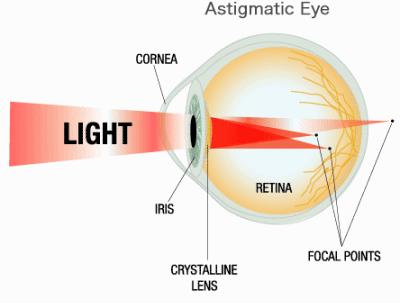 Treatment : Optical treatment : - RGP contact lenses -Hybrid contact lenses -Scleral lenses Surgical treatment: - penetrating keratoplasty 55 56 Anisometropia Difference in refractive power between