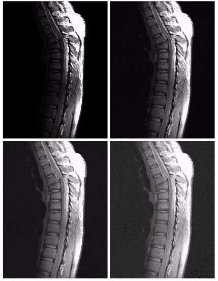 Application: MRI of Human Spine Problem: Picture is too dark Solution: Expansion of lower gray