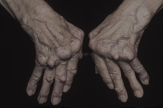 RA SYMPTOMS (*) Rheumatoid Arthritis (RA) is a chronic inflammatory disorder that typically affects the hands and lining of the joints, causing a painful swelling that