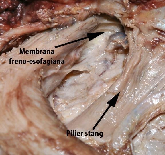 frecvent anterior și la stânga esofagului) ligamentul gastrofrenic devine prin distensie lentă sacul de hernie.