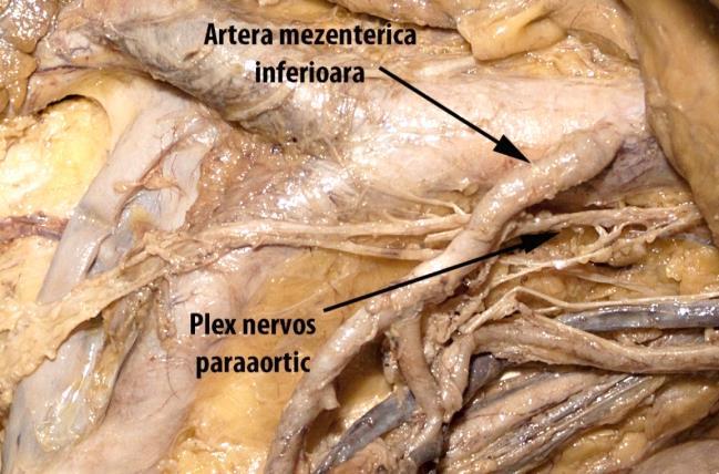 Prin disecția esofagului la nivelul hiatusului, după secționarea membranei frenoesofagiene sau dilacerarea fibrelor sale se poate identifica pleura mediastinală dreaptă (la o distanță medie de