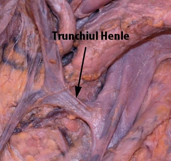 venei mezenterice inferioare lateral față de artera mezenterică inferioară și medial de vasele genitale stângi. Raportul cu ureterul a fost variabil.