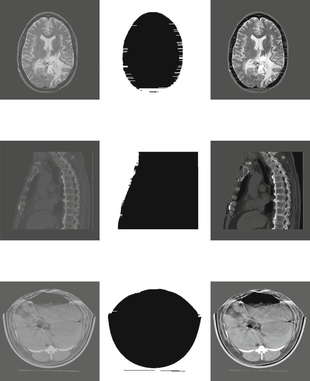 Fig. 7 Embedded only into ROI region of three cover medical images, in which (a,d,g) are original images, (b,e,h) areroi region of three cover images, (c,f,i) are marked-images when embedded maximum