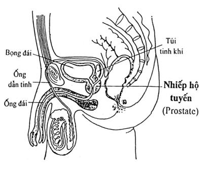 Sưng Nhiếp Hộ Tuyến Nhiếp hộ tuyến (NHT, prostate) hay tuyến tiền liệt là một hạch to cỡ bằng quả mận, và nằm ngay dưới bọng đái của đàn ông, bao quanh niếu đạo (ống đái), có nhiệm vụ tiết ra tinh