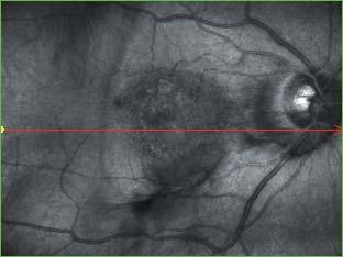 Retina Analysis AMD (Age-related Macular Degeneration) High quality SLO image