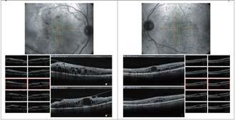 function allows greater resolutions of vitreous retina images by adjusting