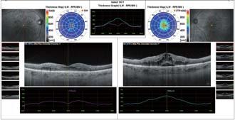 Ultra fine Retinal CSC (Central Serous Chorioretinopathy) Choroidal OCT image