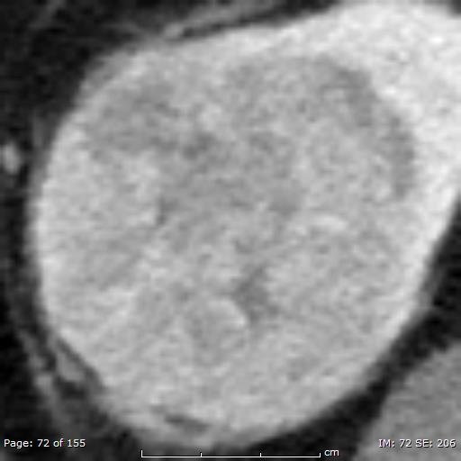 Texture of a renal cancer IR MBIR Cancer +