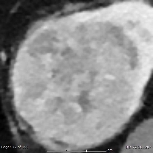 noise pixels projecting over the tumor that