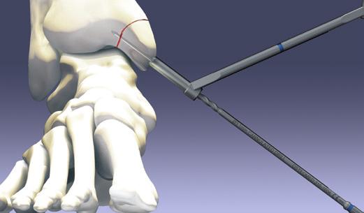Surgical Technique Medial Malleolar Fracture (Cont.) 3. Pre-drilling and Tapping (Optional) The ExtremiFix Midsize I Large Cannulated Screws are selfdrilling and self-tapping.