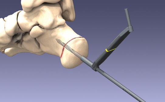 Surgical Technique Calcaneal Osteotomy (Cont.) 3. Pre-Drilling and Tapping (Optional) The ExtremiFix Midsize I Large Cannulated Screws are self-drilling and self-tapping.
