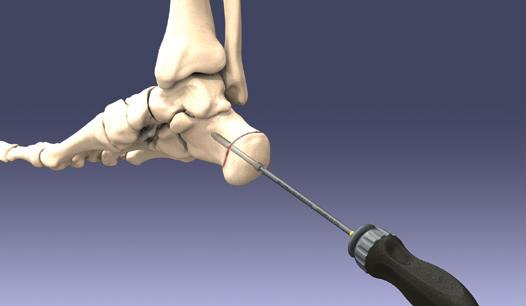 Surgical Technique Calcaneal Osteotomy (Cont.) 5. Screw Placement Select the appropriate screw length and insert screw over the guide wire using the cannulated driver stem and ratcheting handle.
