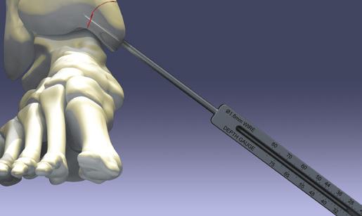 When placing more than one screw, ensure that subsequent guide wires do not interfere with other implants. 4.