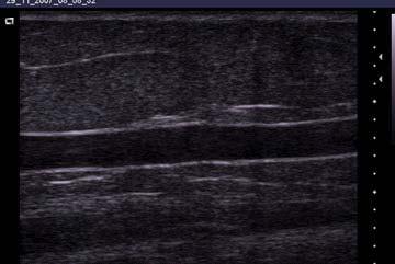 Optimizing the ACUSON X150 for the Phlebology Exam Focal Zone - focus the ultrasound waveform to enhance the sharpness of