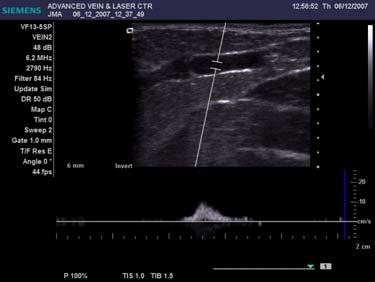 Optimizing the ACUSON X150 for the Phlebology Exam Spectral Doppler - the scale should be set
