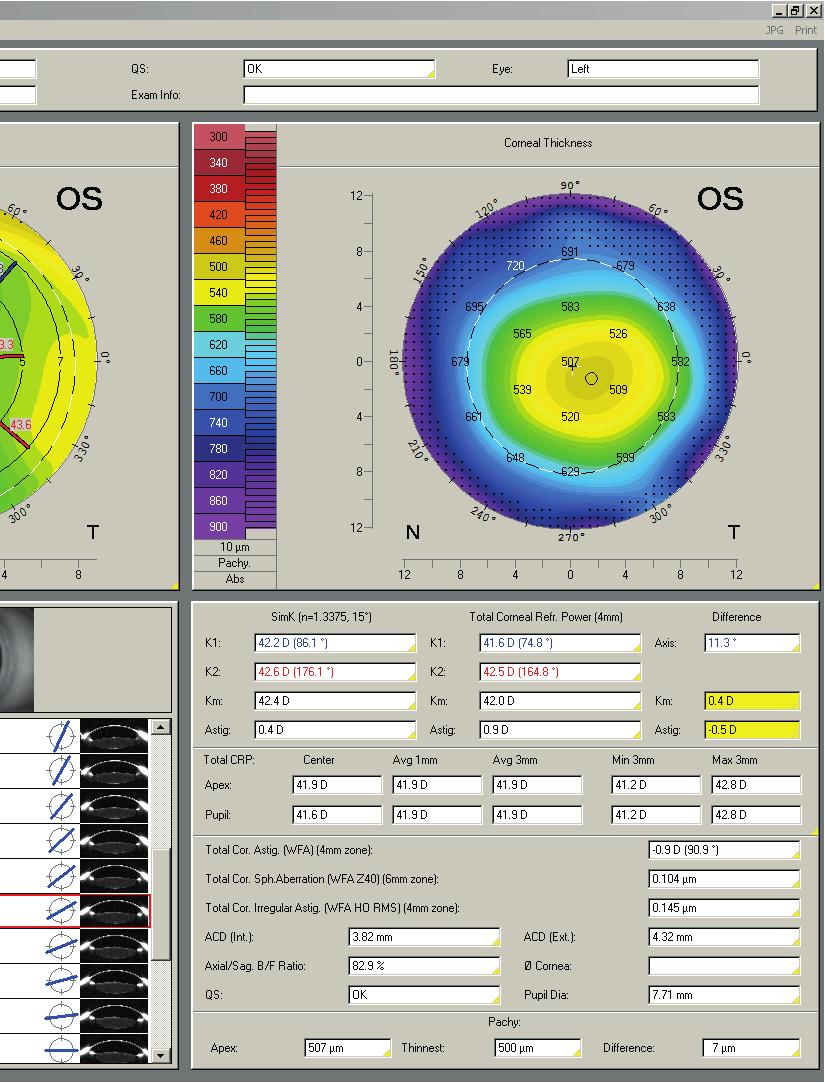 Total corneal astigmatism + Axial length + IOL formula = Optimal IOL Cataract Pre-OP Display Cataract Pre-OP Display was developed in collaboration with Prof. Dr.