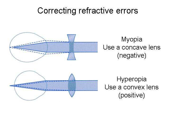 Slide 15 If the eyeball is the wrong shape (or less commonly, the cornea or lens are the wrong shape) we get a refractive error.